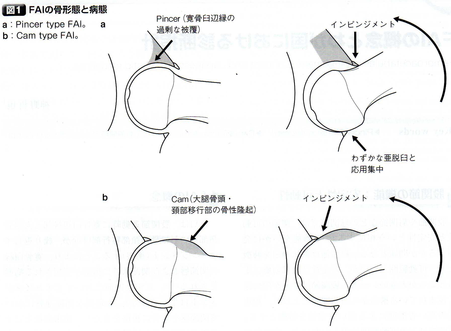 現場で使える 股関節インピンジメント Fai のリハビリテーションの進め方 理学療法士の働き方改革