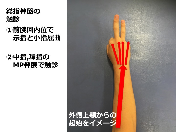 伸筋の触診できている? 上腕骨外側上顆炎(テニス肘)の評価と理学療法!